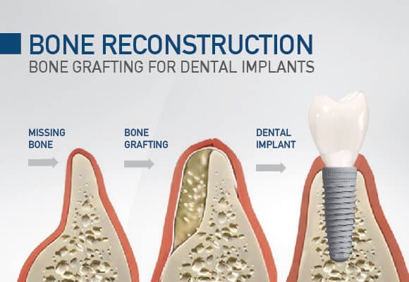 Bone Implant Specialist - Bone Implant Surgery & Maintenance - Smile Dental